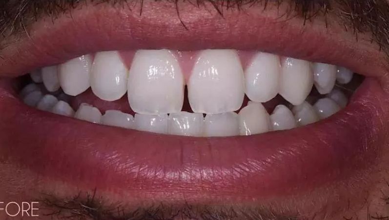 Before - Teeth Whitening Foster Ave Chicago