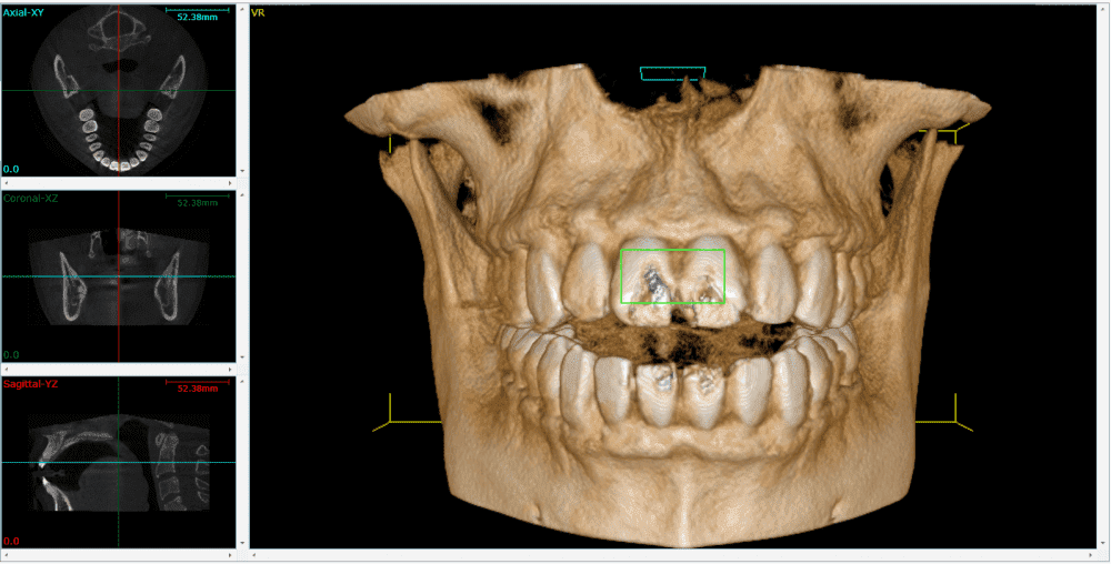 Orthodontics Foster Ave Chicago - 2D X-rays