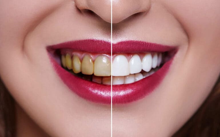 Teeth Whitening Foster Ave Chicago