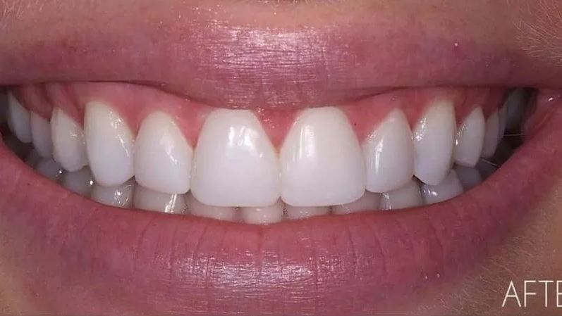 After - Teeth Whitening Foster Ave Chicago