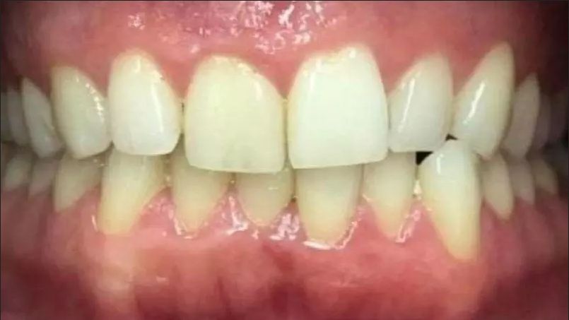BEFORE-INVISALIN-compressed
