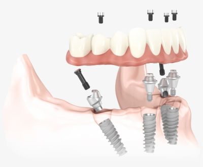 130-1309531_all-on-4-implants-zygomatic-implants-implant-dentures